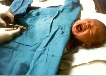 circumcision_screaming_baby